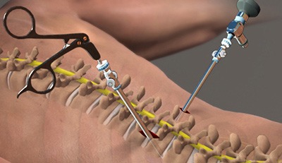 Do You Need Major Spine Surgery